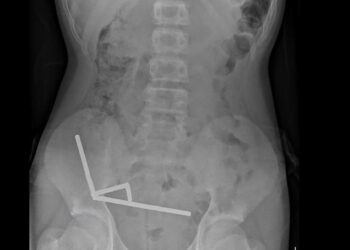 Surgeons remove up to 100 magnets from N. Zealand teen’s gut