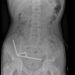 Surgeons remove up to 100 magnets from N. Zealand teen’s gut